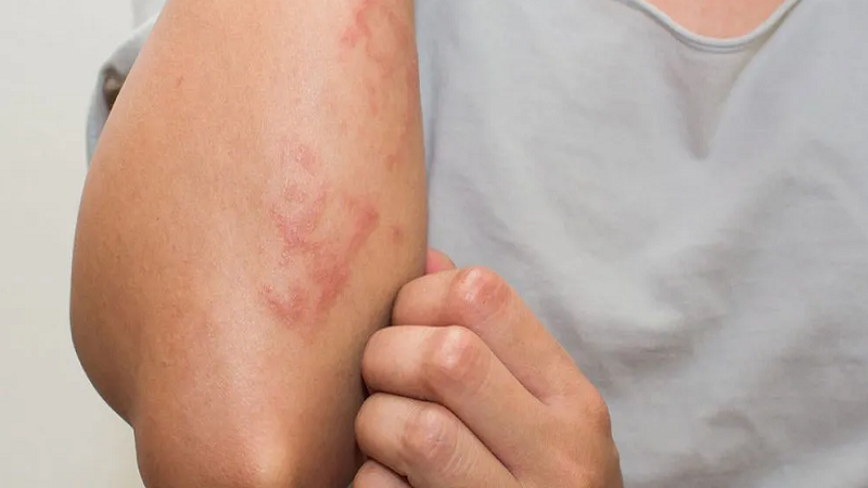 Why Drug-Related Skin Infections Are Becoming a Bigger Hospital Story