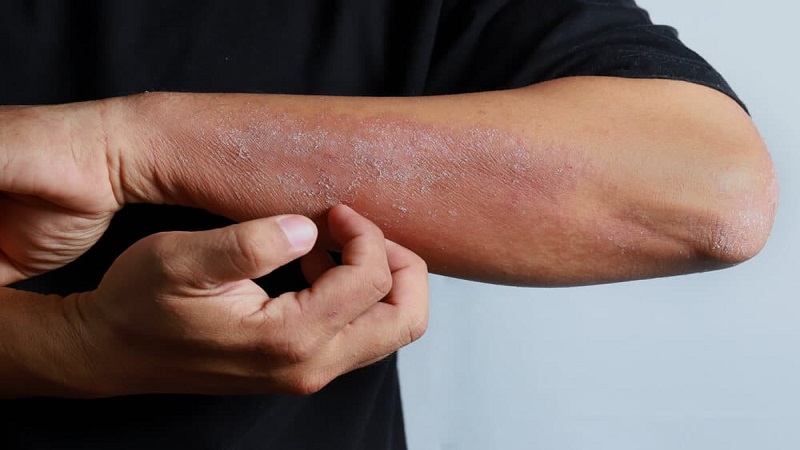 The Hidden Infection Risk Showing Up on the Skin of People Who Inject Drugs